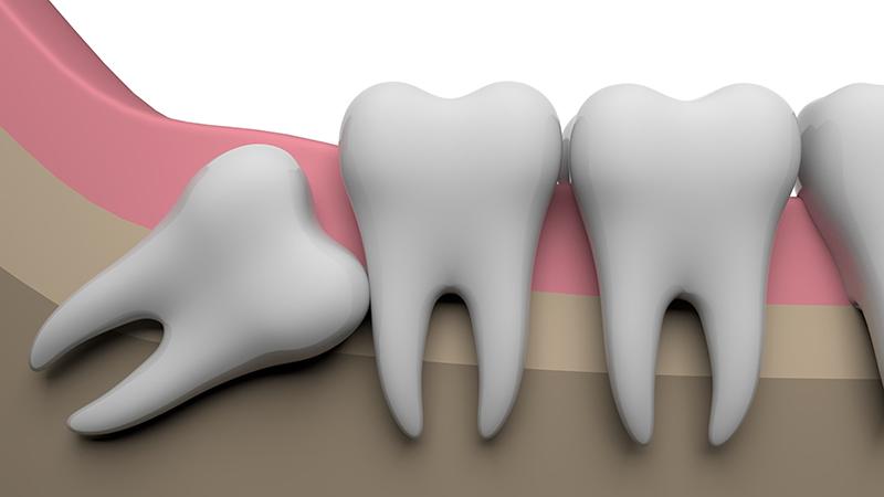 口腔外科の代表例「親知らずの抜歯」