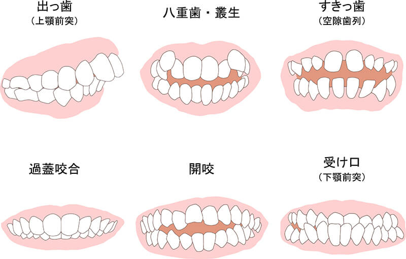 不正咬合（乱れた咬み合わせ）が全身に与える影響とは