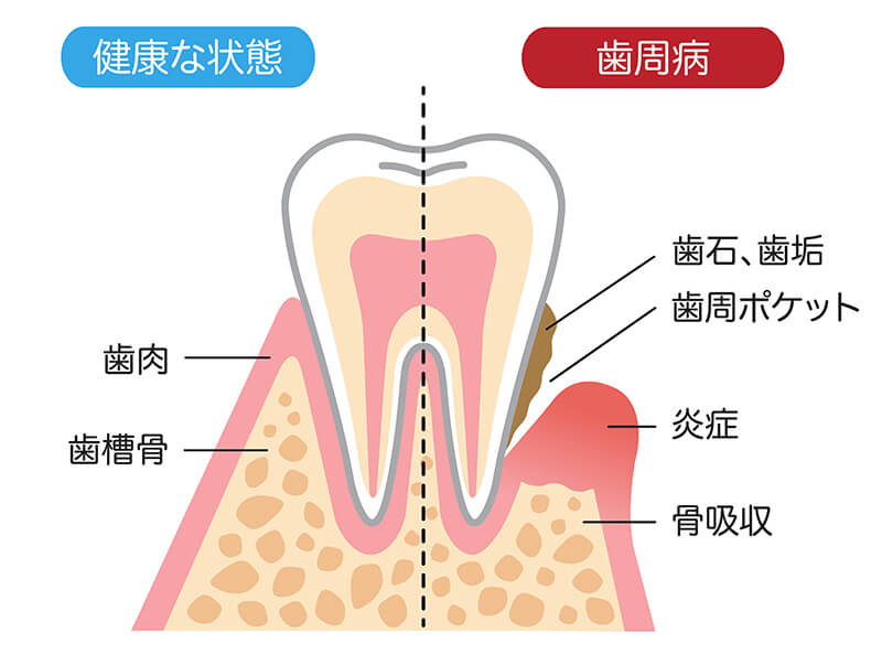 歯を失う原因第一位「歯周病」