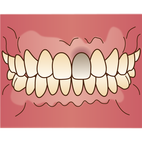 失活歯